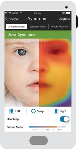 face2gene-analysis-263x500.jpg